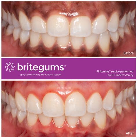 The Alternative to Gum Bleaching - BriteGums