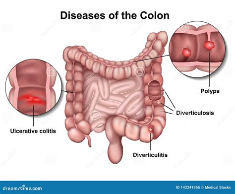 Diseases Of The Colon 3d Medical Illustration On White Background Stock ...