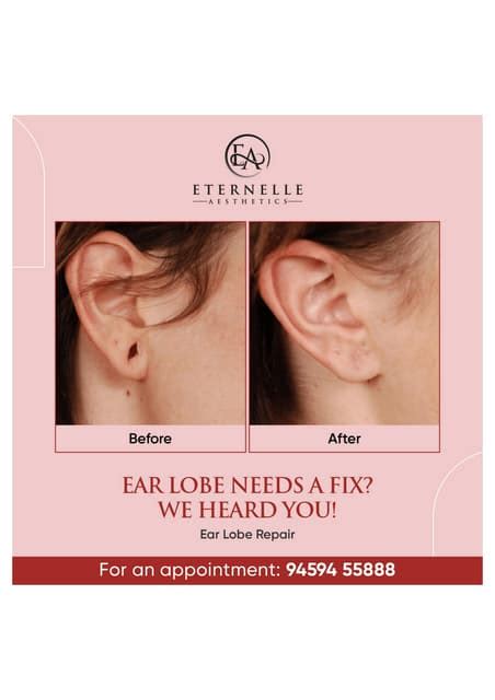 Ear Lobe Repair procedure eternell aesthetics.pdf | Free Download