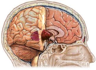 The Facts - Dealing with Malignant Astrocytoma - Brain-Surgery.com