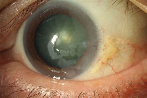 Marginal Corneal Degeneration