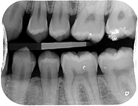 Types of Dental Radiographs and their Uses - dentalnotebook