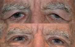 Eyelid Surgery Niles | Ptosis Norwood Park | Dermatochalasis IL