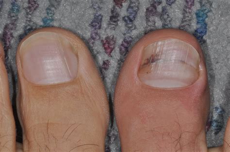 Foot and Ankle Problems By Dr. Richard Blake: Ingrown Toenail: Email Advice to a Friend