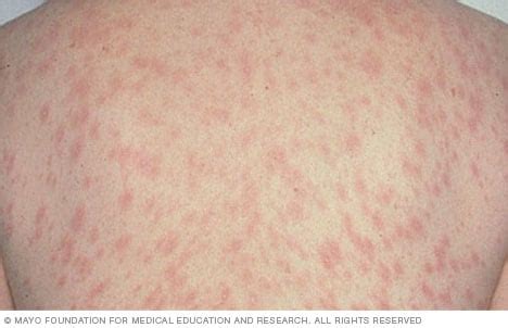 Pityriasis rosea (rash) on light skin - Mayo Clinic