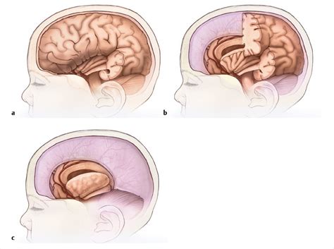 21 Anatomical Hemispherectomy | Neupsy Key