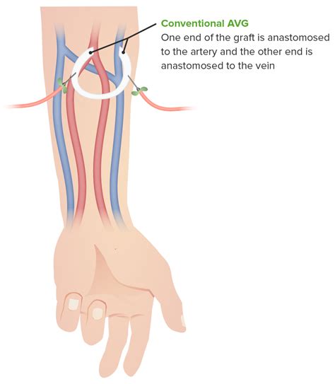 Dialysis: Types and Overview | Concise Medical Knowledge