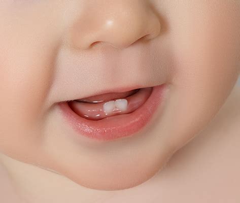 Baby Teeth - When Should They Show - Kiddies Dental Care