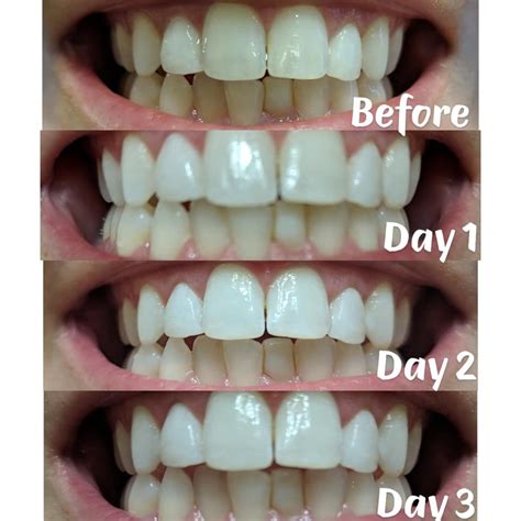 Pin on Teeth whitening ideas