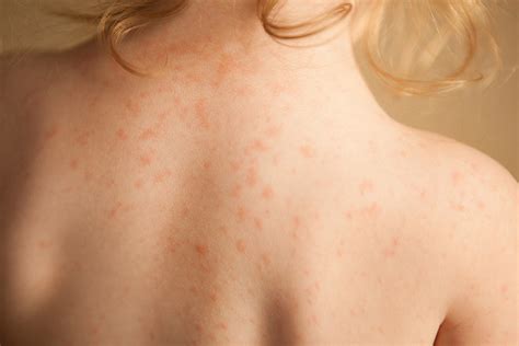 Heat Rash Treatment Rash Under The Breast: Causes And When To See A Doctor - Cooper Noriega Death