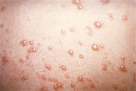 Varicella: Chickenpox and Shingles | Vermont Department of Health