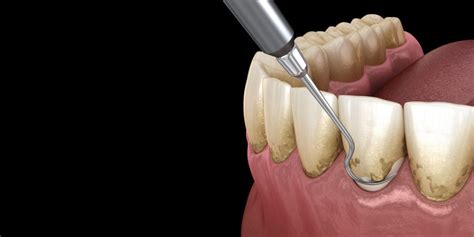 Scaling and Root Planing | Gum Disease | Pittsfield, Massachusetts