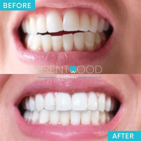 Invisalign® Clear Aligners Brentwood, Los Angeles | #1 Orthodontist