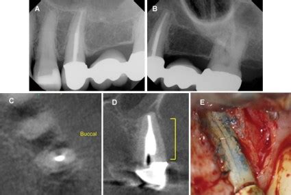 Approaches to Nonsurgical Root Canal Retreatment