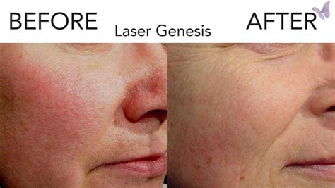 laser genesis at home - healthyhappylady