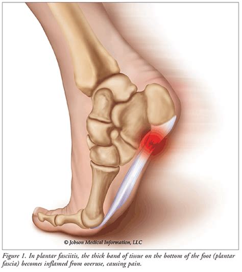 Common Foot Pain Issues