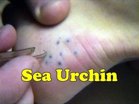 Sea Urchin Spine Sting Removal Attempt - Maui Hawaii - Daredevil Girl - YouTube