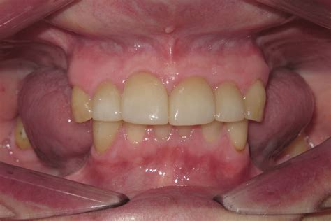Removable Partial Dentures Smile Gallery - Raber Dental, Kidron Dentist