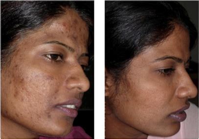 Laser Treatment For Dark Spots On Black Skin : Removing Dark Spots From ...