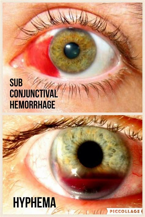 Subconjunctival hemorrhage v. Hyphema #NaturalHomeRemediesForCold in 2021 | Natural remedies for ...
