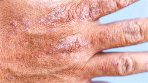 Atopic Dermatitis Images