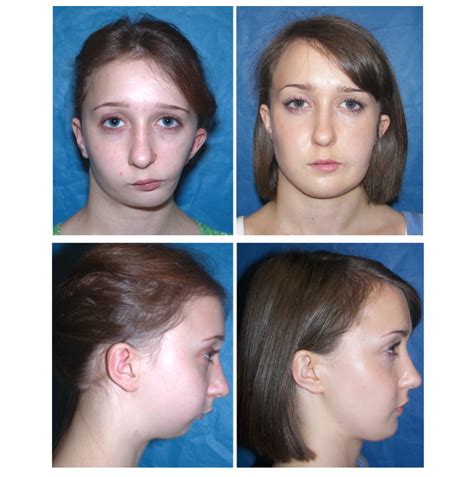 Before and After Photos Maxillofacial Surgery - Larry M. Wolford, DMD