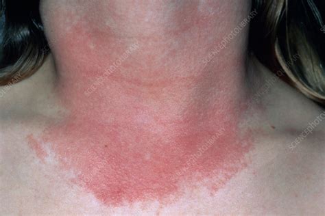 What Causes Red Rash On Chest - Design Talk