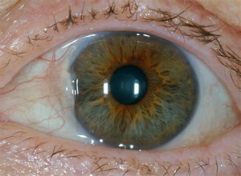 Bumps on eyeball: Causes, types, and treatment