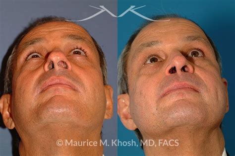 10+ Nasal Valve Collapse Surgery Before And After - SaphireAmmara