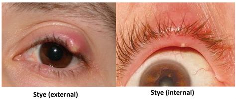 Swollen Eyelid - Know the causes, remedies and alert signs