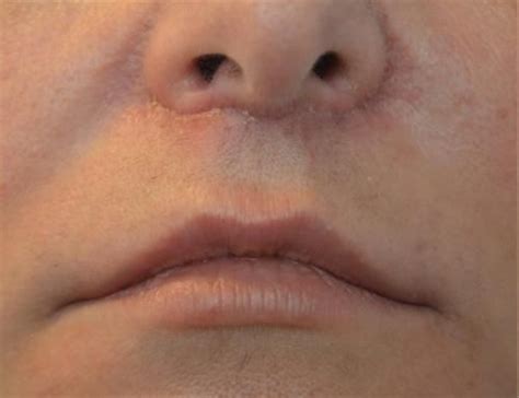 Dimpleplasty After Photo | Yorkville, Toronto | Visage Clinic: Dr. Marc DuPéré | Facial ...