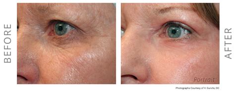 NeoGen Plasma Skin Regeneration | Columbus | Nina Deep, MD