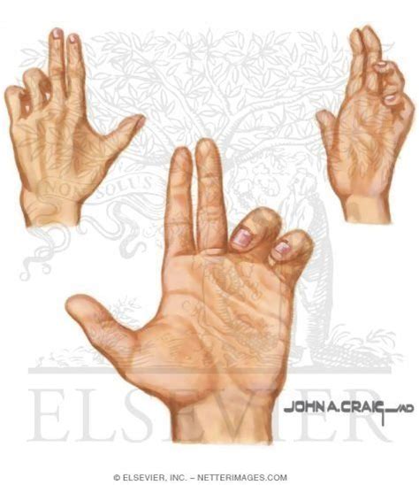 Hand of Benediction - Netter Medical Images | Medical illustration ...