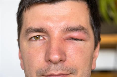 Premium Photo | A red swollen eyelid on a man's face in closeup is an allergy to an insect bite ...