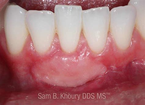 Gum Grafts Before and After - Dr. Sam Khoury