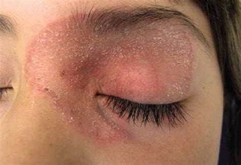 12 Skin Rash On Eyelid Eyelid eyelids rash itchy psoriasis swollen causes eyes dry infection ...