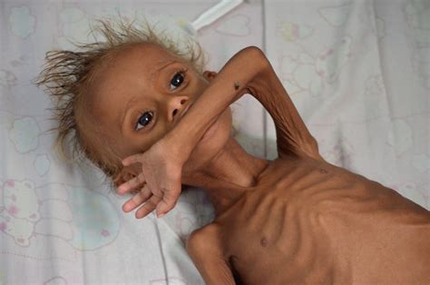 Yemen's coast struggles with severe malnutrition as conflict drags on - CBS News