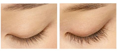 Latisse Eyelash Enhancement: A Helpful Overview | MD Beauty Clinic