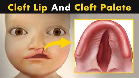 What Causes Cleft Lip And Cleft Palate? | symptoms, Causes And Treatment (Urdu/Hindi) - YouTube