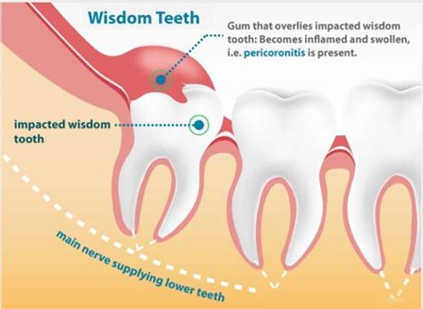 How To Help Wisdom Tooth Pain - Askexcitement5