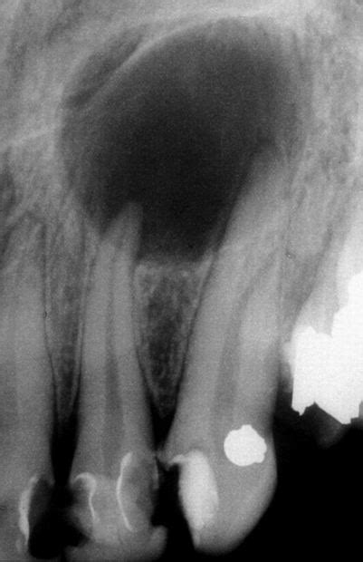 Radicular cyst - Differential diagnosis