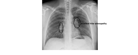 Differential Diagnosis of Bilateral Hilar Lymphadenopathy - Medical Zone