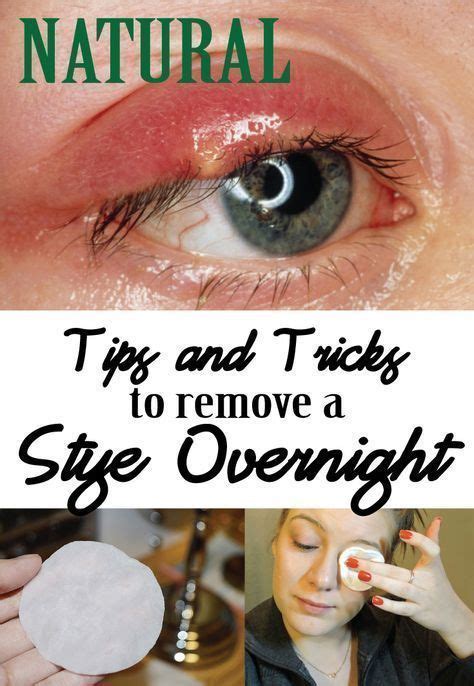 Skin Care Advice That Can Really Help You | Eye stye remedies, Stye remedy, Sty in eye remedies