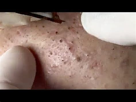 BLACKHEADS REMOVAL