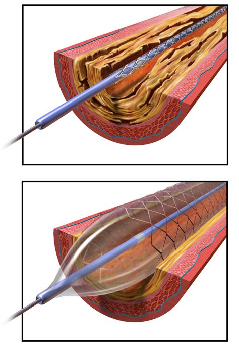 File:Angioplasty - Balloon Inflated with Stent.png - Wikimedia Commons