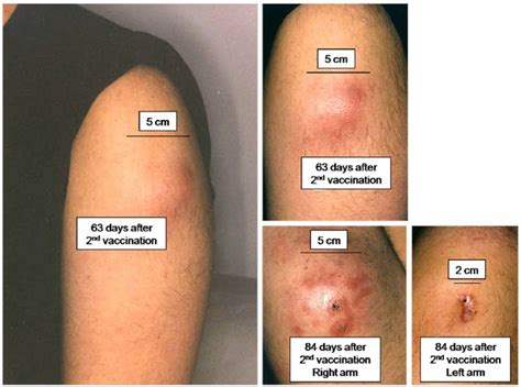 Bilateral Gluteal Abscesses With Gas Extending Around - vrogue.co