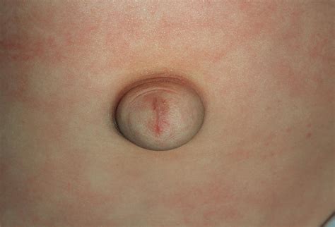 Hernia Epigastrica Em Bebe - MODISEDU