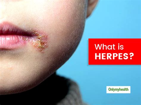 What Is Herpes? Know Its Types, Causes, Signs And Treatment From A E32