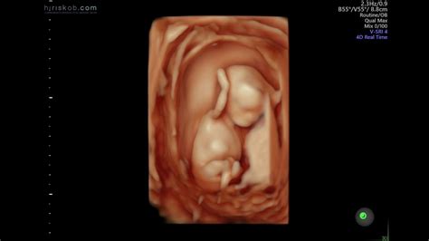 Baby Hallak #3 || 3D 4D Ultrasound at 12 Weeks Pregnant - YouTube