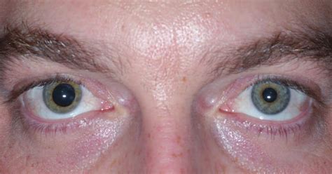 Study Medical Photos: Anisocoria